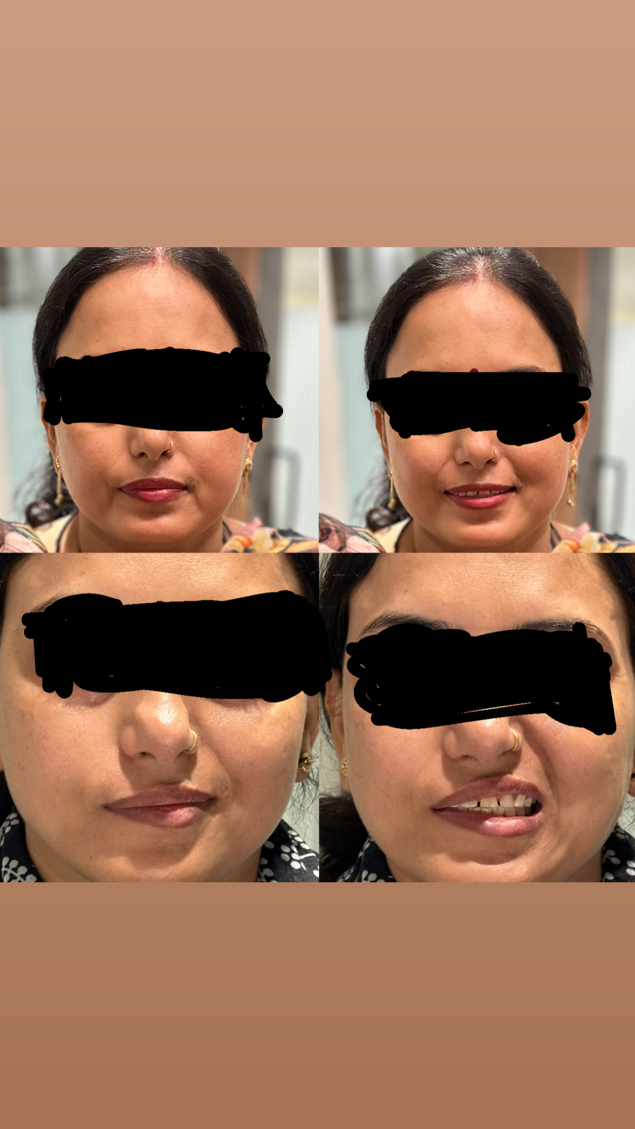 Bell's Palsy — From a Crooked Smile to Complete Recovery: How Early Diagnosis and Targeted Treatment Made All the Difference