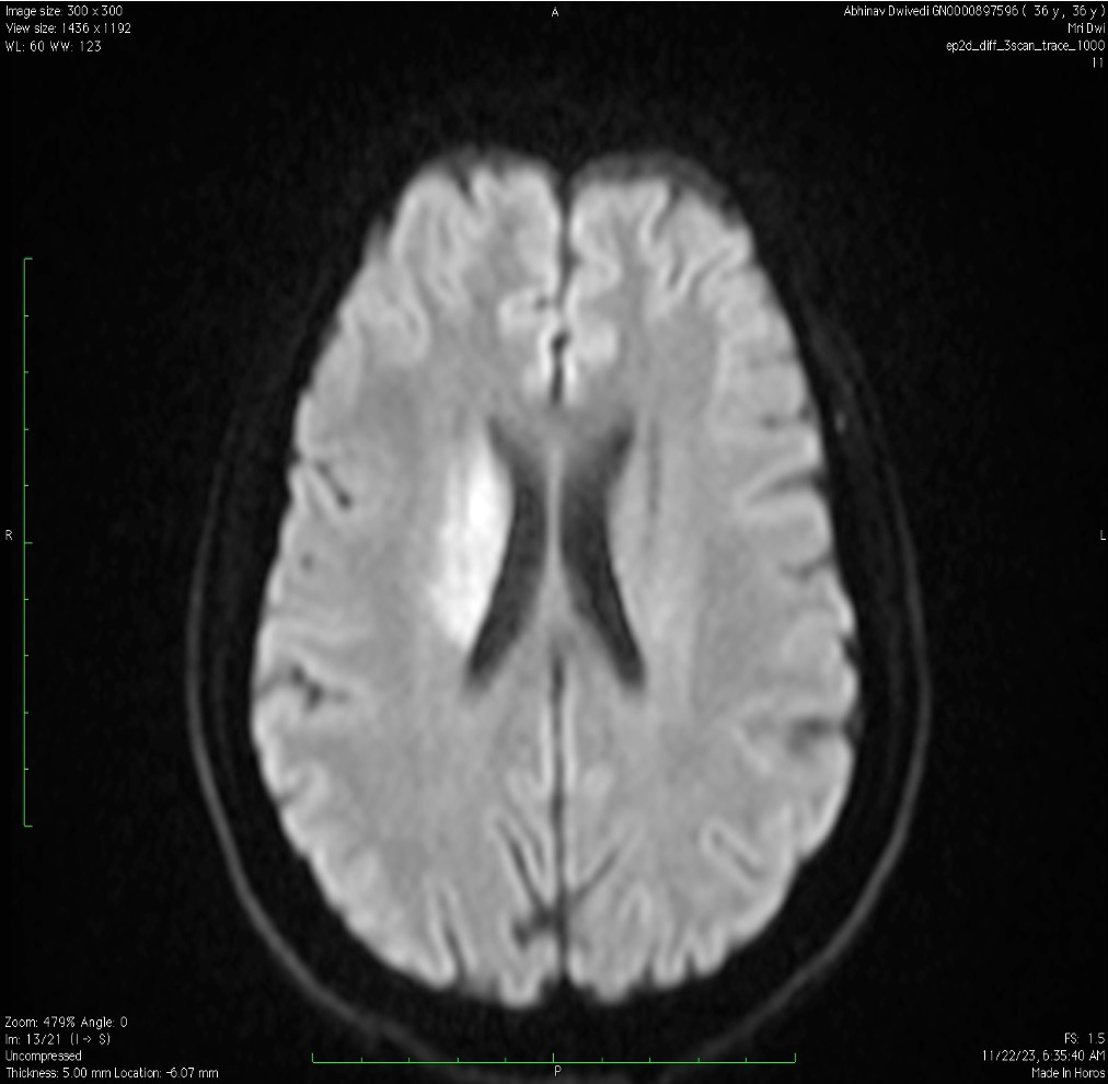 Young Stroke in a 36-Year-Old Male — When Lifestyle Became the Culprit