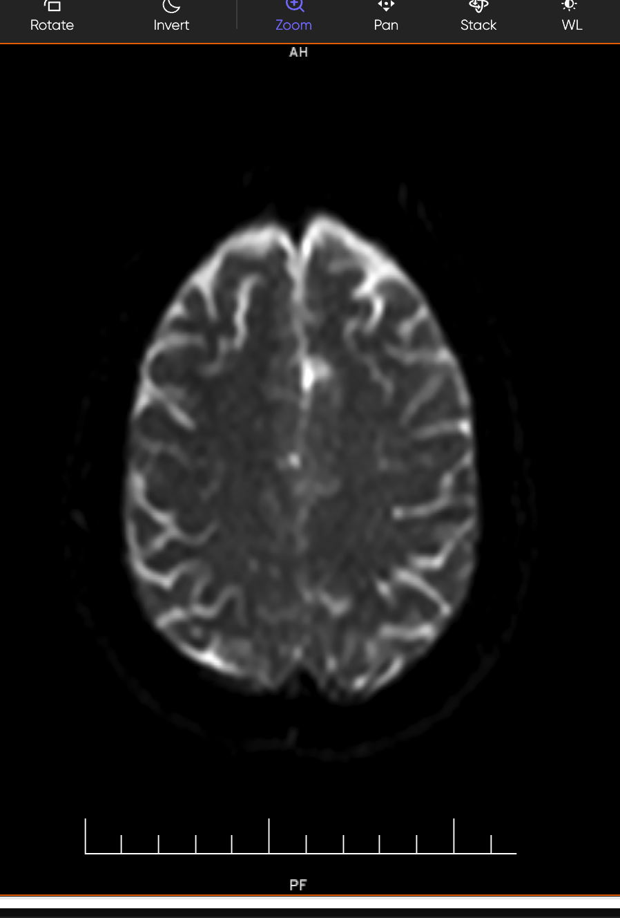 Atypical Stroke in a 57-Year-Old Woman — When Brain Fog and a Headache Were the Only Warning Signs