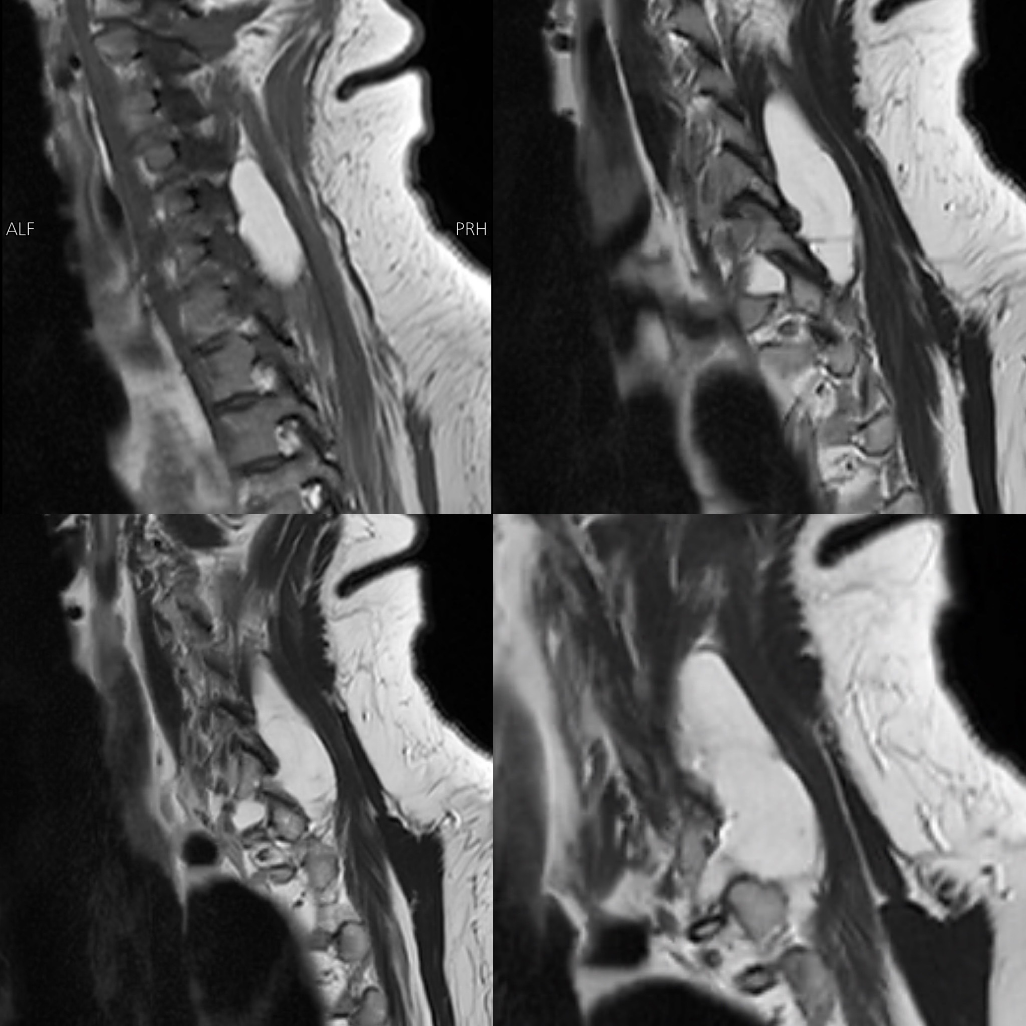 Bedridden with Dizziness — When the Brain Scan Raised Alarms but the Bedside Exam Told the Truth