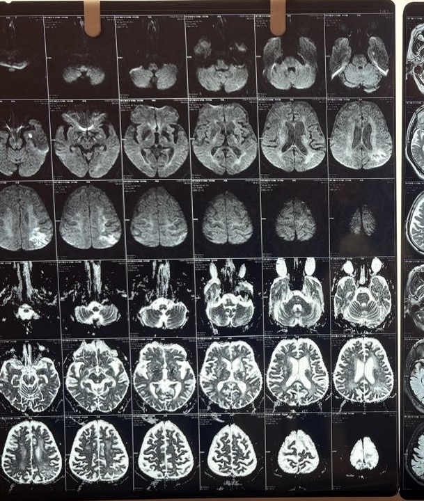 When "Just Forgetfulness" Is a Stroke in Disguise: Acute-on-Chronic Cerebrovascular Disease Presenting as Dementia — clinical image