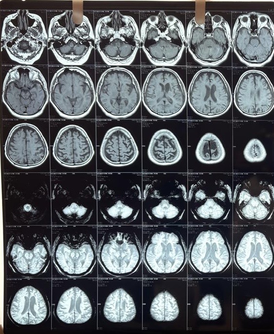 When "Just Forgetfulness" Is a Stroke in Disguise: Acute-on-Chronic Cerebrovascular Disease Presenting as Dementia — clinical image
