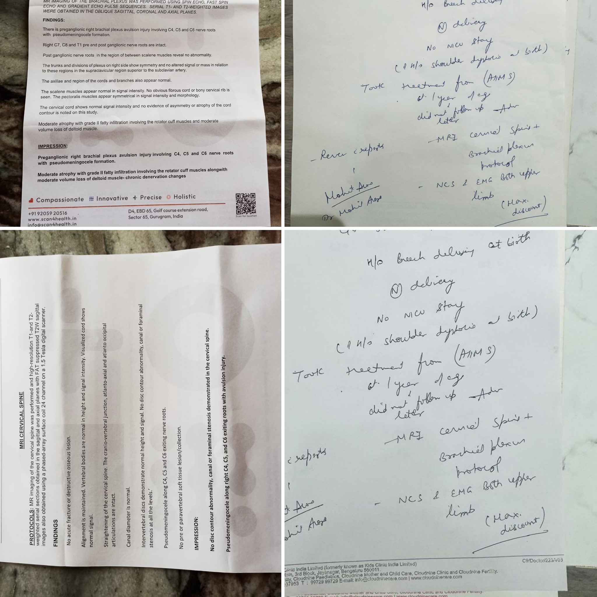 Six Years of a Limp Arm: How MRI Revealed a Missed Birth Injury Nobody Had Named — clinical image