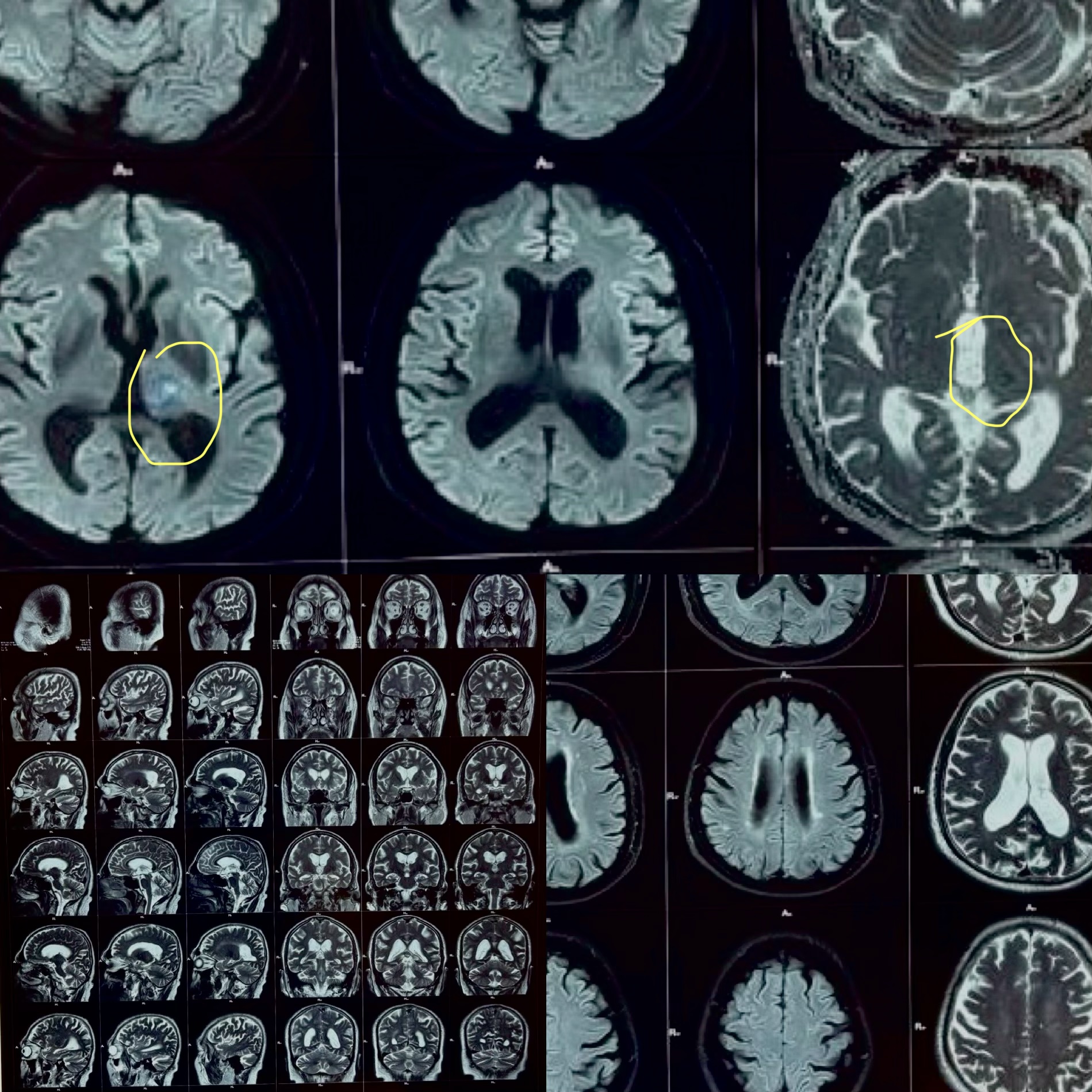 Recurring Hand Numbness That Was Actually a Stroke: A Thalamic Infarct Case — clinical image