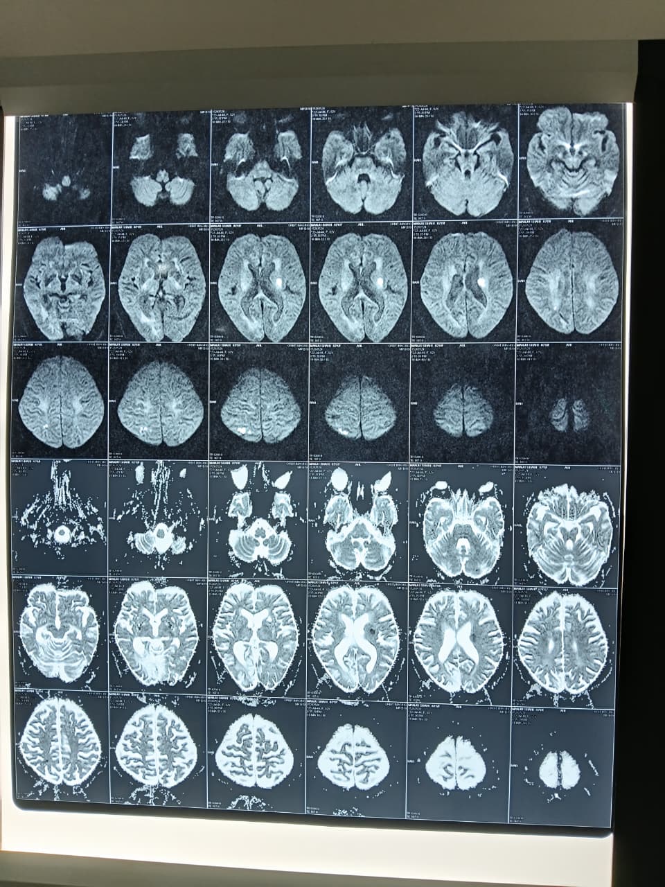 Multiple Acute Strokes in an 82-Year-Old: A Tobacco and BP Story — clinical image