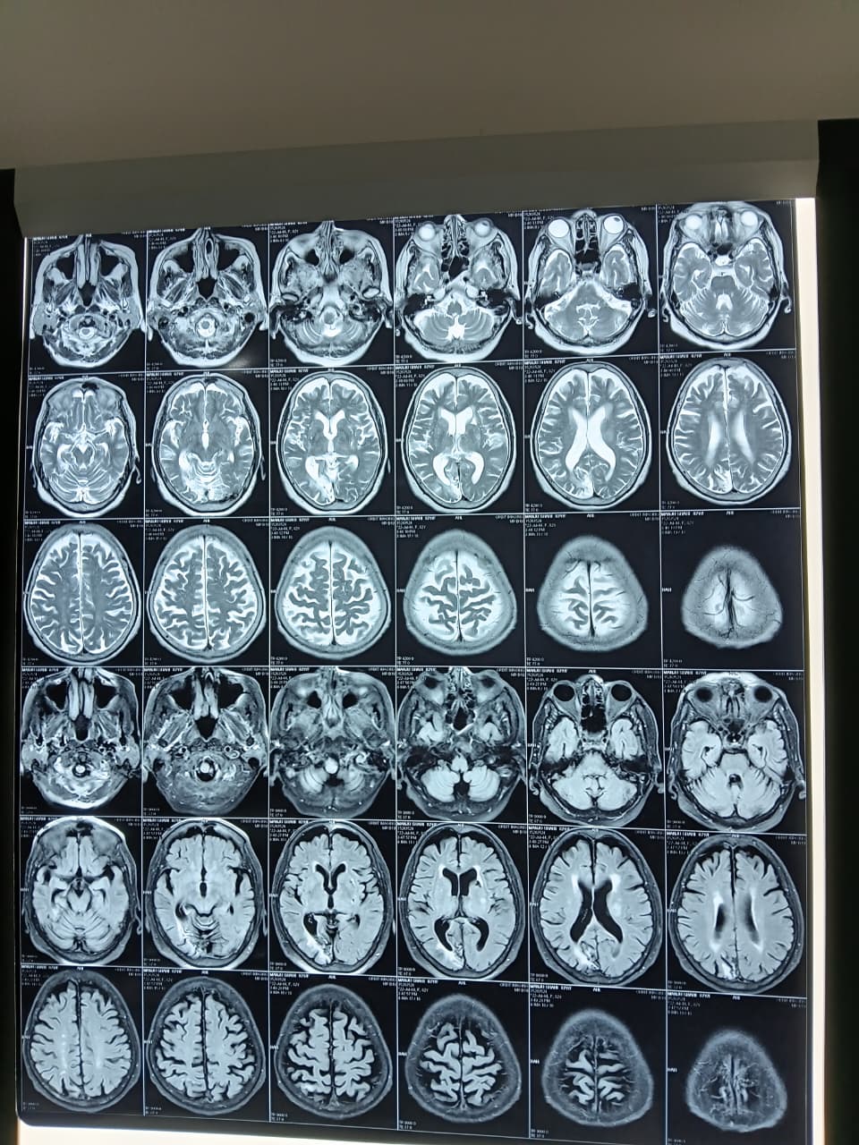 Multiple Acute Strokes in an 82-Year-Old: A Tobacco and BP Story — clinical image