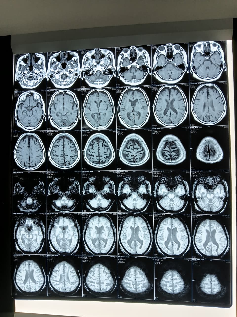 Multiple Acute Strokes in an 82-Year-Old: A Tobacco and BP Story — clinical image