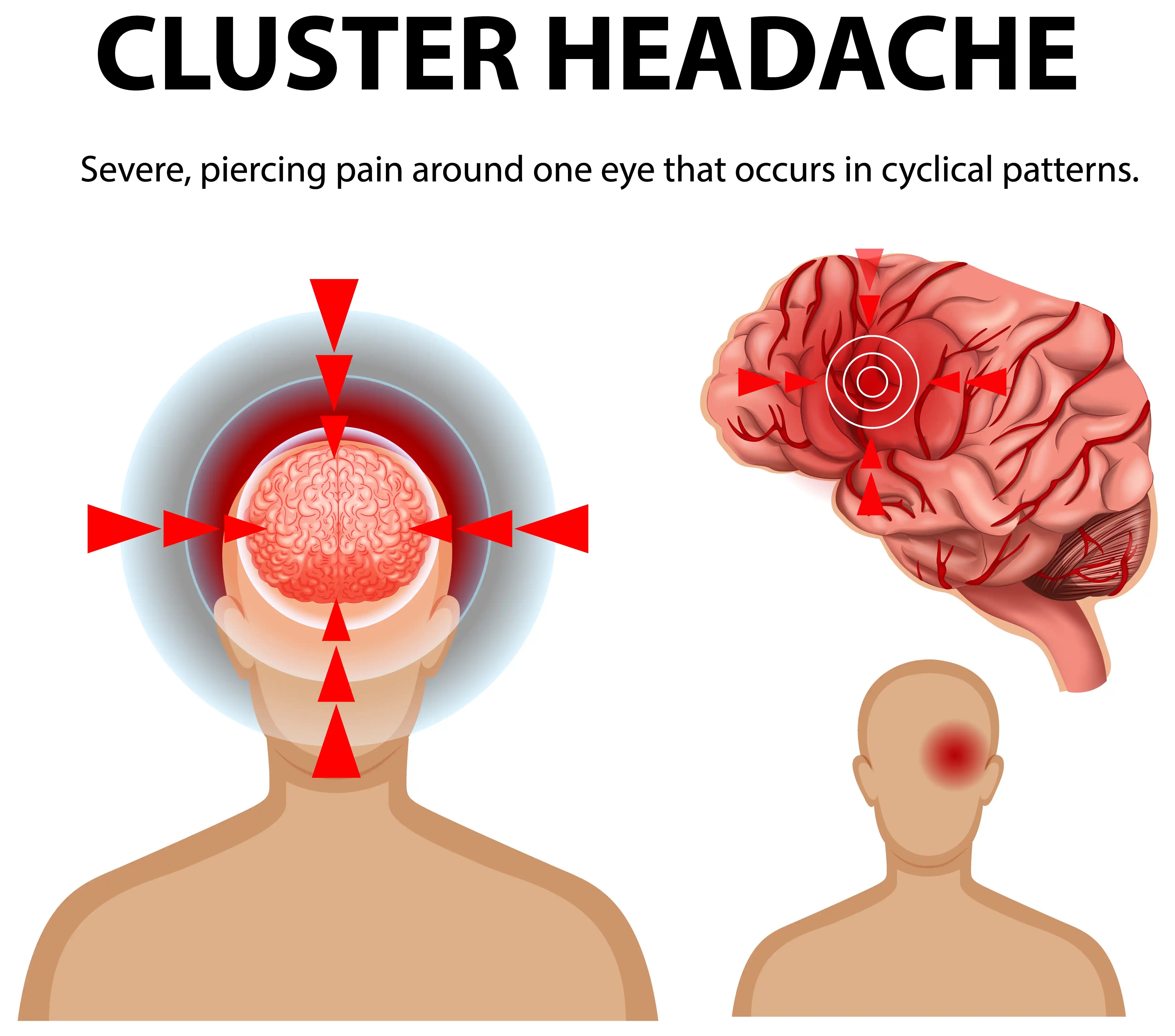 Cluster Headache: The Most Painful Headache You Have Never Heard Of