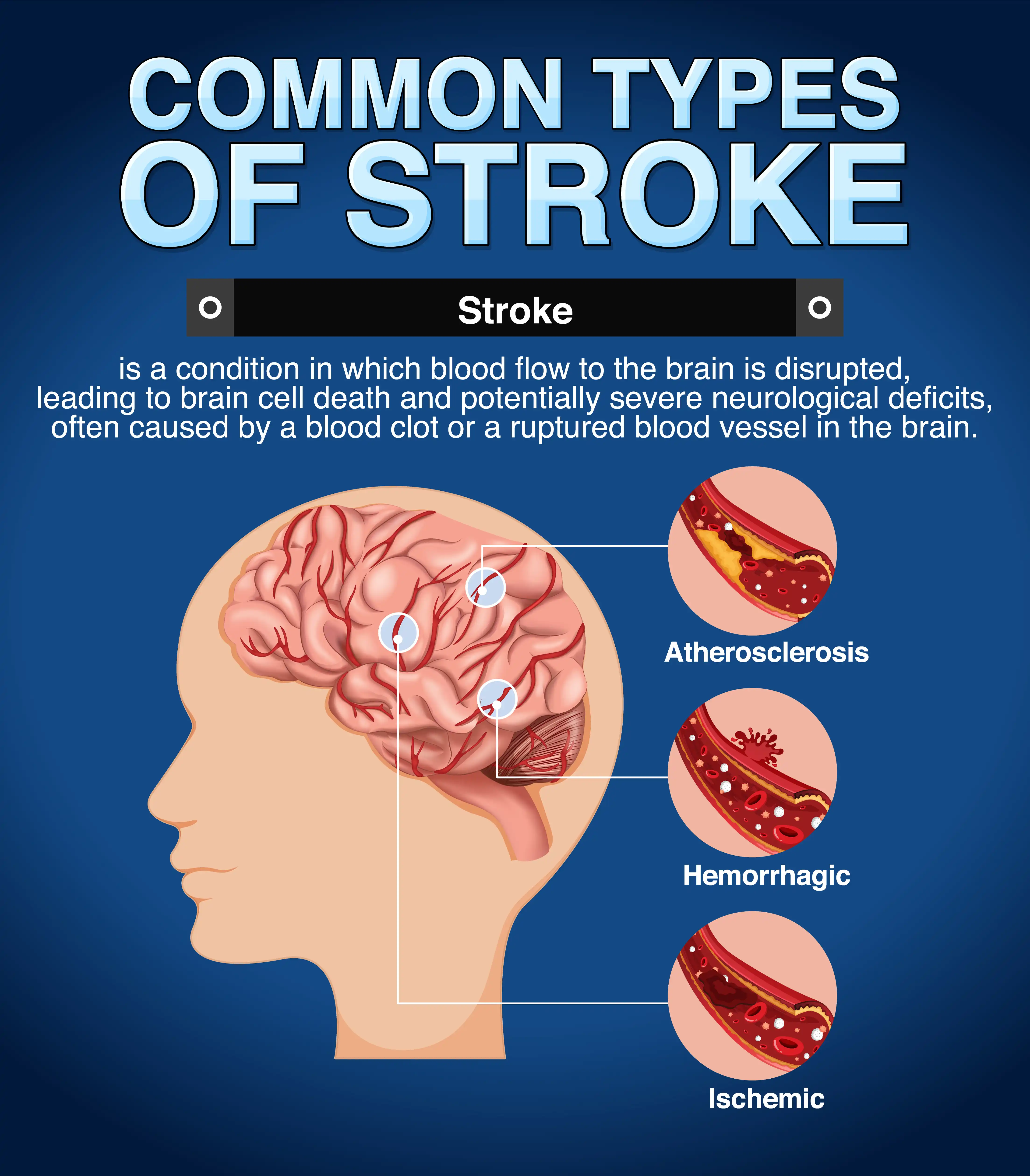 Stroke: How to Spot It in Seconds, and Why Every Minute Costs You Brain